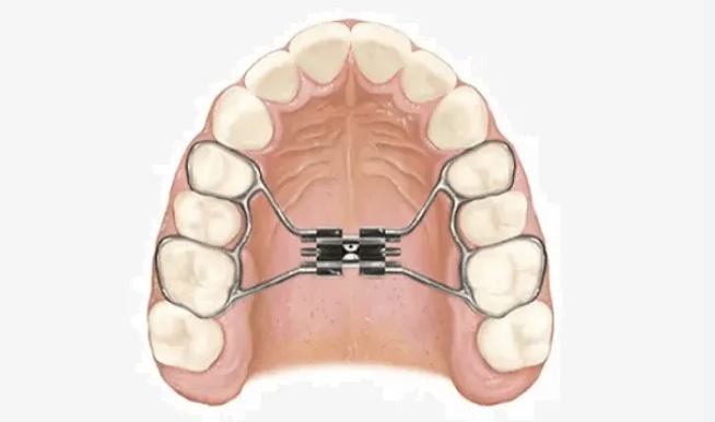 Cuidados del disyuntor dental durante un tratamiento de ortodoncia infantil