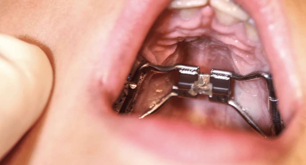 odontopediatra valorando el desarrollo del paladar de un niño